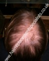  - Before Treatment