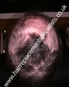  - Before Treatment